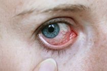 Tipps bei Augenentzündung