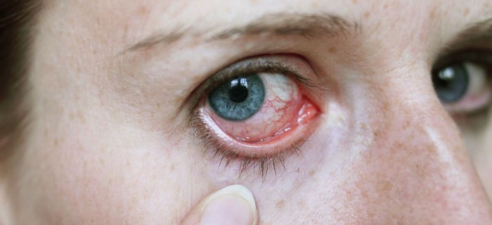 Tipps bei Augenentzündung